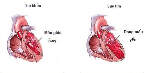 Congestive Cardiac Failure(CHF) - Hình ảnh minh họa
